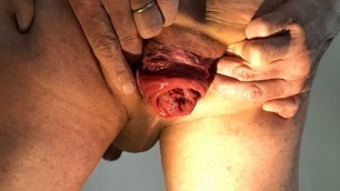 I'm happy to present you my anal prolapse